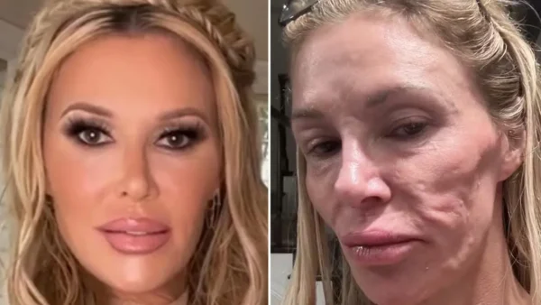 Brandi Glanville face: cirurgia invasiva hoje busca parasita raro