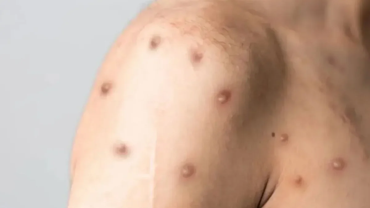 Mpox no Rio cresce 700% e capital fica sem vacina para risco