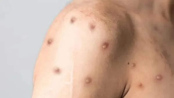 Mpox no Rio cresce 700% e capital fica sem vacina para risco